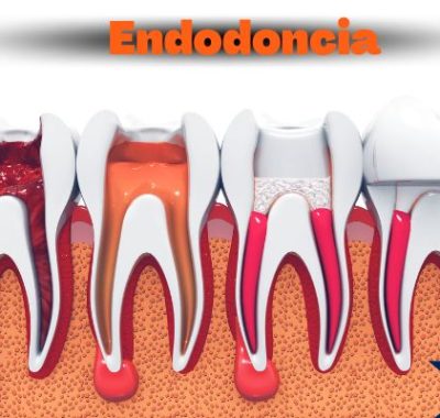 como tratar la endodoncia